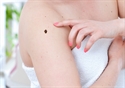 Melanoma